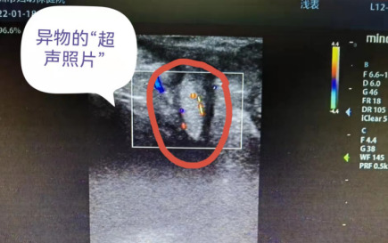 4歲女童陰道流血，一查竟發(fā)現(xiàn)異物